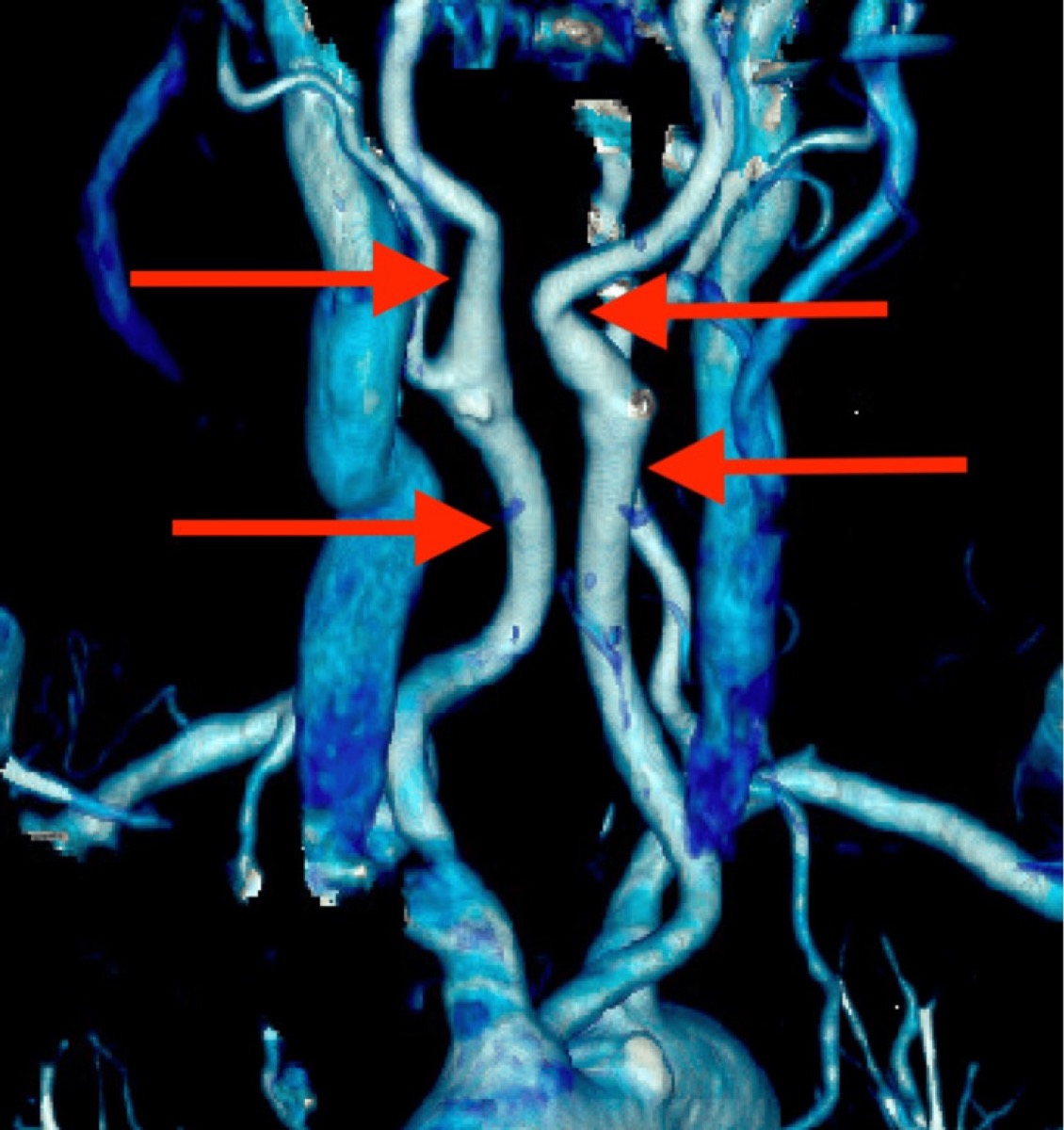 Coronal CT angiogram — medialized common/internal carotid arteries overlying the prevertebral space (a "kissing carotid" variant)