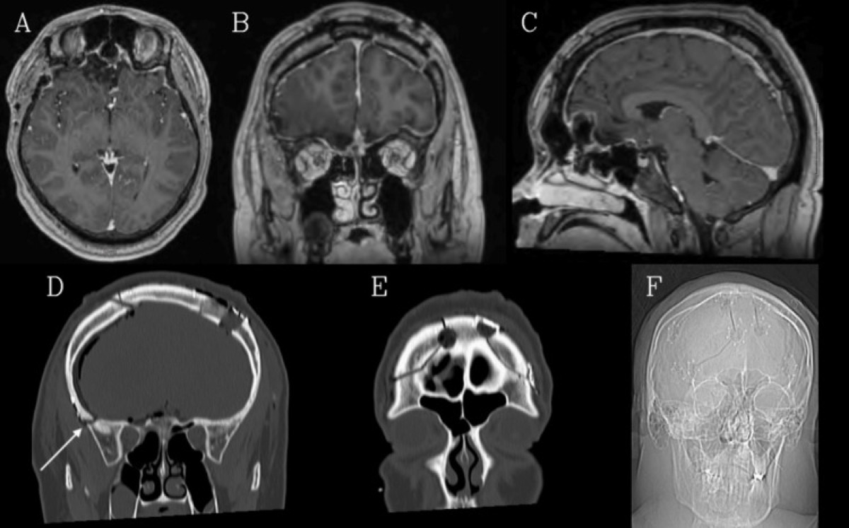Postoperative CT — bilateral frontal craniotomy outlines of the bifrontal approach