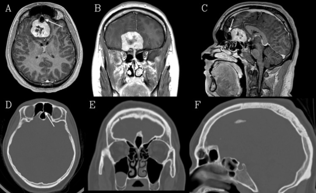 Olfactory groove meningioma — T1 post-contrast MRI (axial/coronal/sagittal) with an aerated crista galli abutting the tumor (a CSF-leak pitfall)