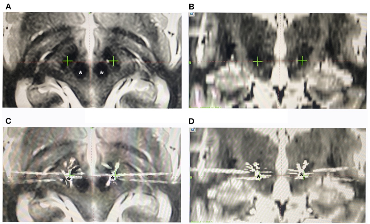 DBS targeting — preoperative MRI plan (targets along the anterior edge of the red nucleus) and postoperative CT–MRI fusion verifying lead location