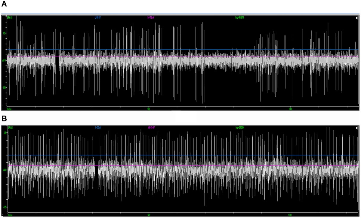 Intraoperative microelectrode recording — characteristic STN signal (high background, irregular firing) versus SNr (lower noise, regular high-frequency)