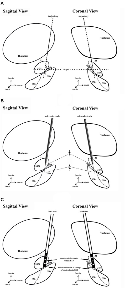 DBS surgical workflow — preoperative trajectory planning, intraoperative microelectrode recording/microstimulation, and lead-placement assessment