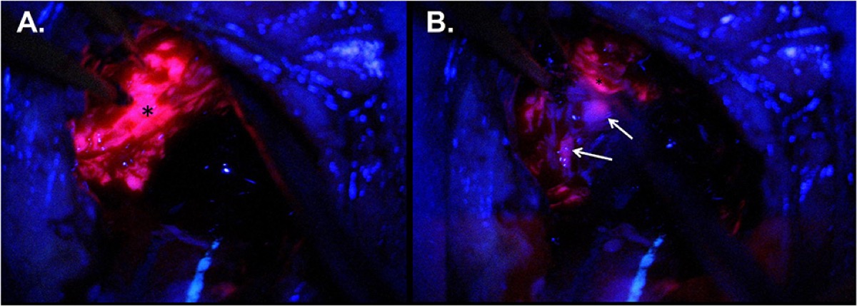 Intraoperative 5-ALA (PpIX) fluorescence — pink tumor bulk (asterisk) and infiltrative margin (white arrows) under violet light