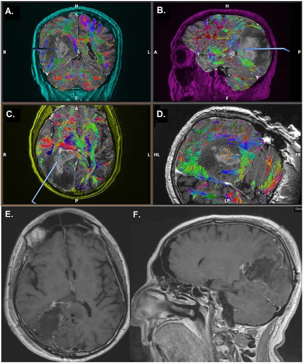 Glioblastoma — preoperative MRI with DTI tractography (A–D) and postoperative MRI showing gross total resection (E–F)