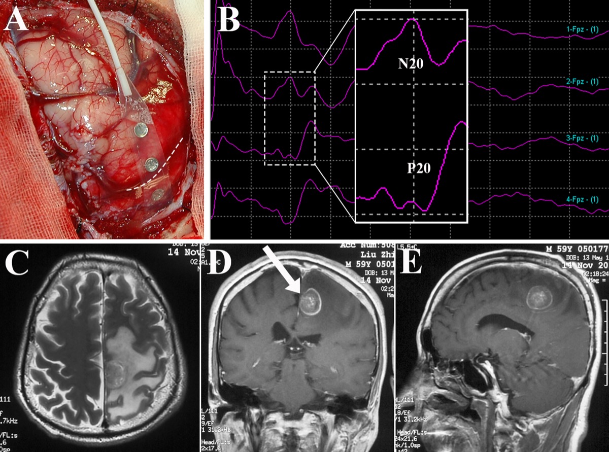 Intraoperative brain mapping — subdural strip SEP N20 phase-reversal localizing the central sulcus before resection
