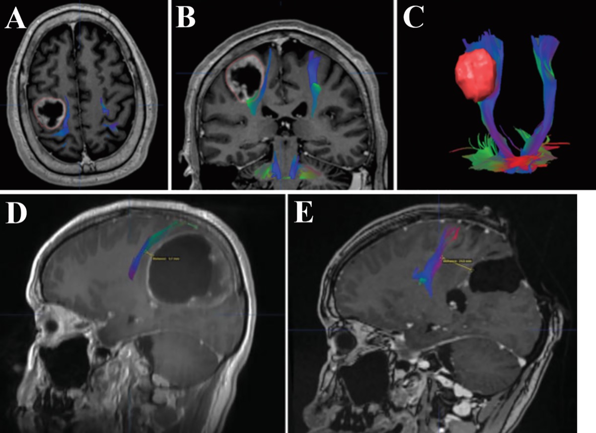 Metastasis adjacent to the corticospinal tract — merged DTI + contrast T1 MRI with 3D tract reconstruction and postoperative MRI confirming resection