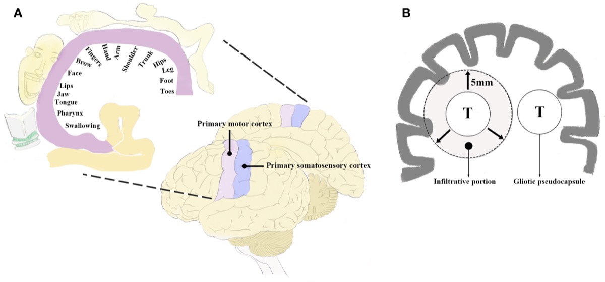 Perirolandic region — motor/sensory homunculus and the infiltrative growth pattern of brain metastases beyond the gliotic pseudocapsule