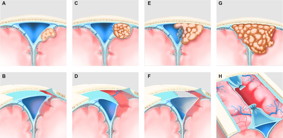 Parasagittal meningioma — classification by superior sagittal sinus involvement (Type I patent → Type III complete occlusion) with corresponding resection / sinus-management strategy