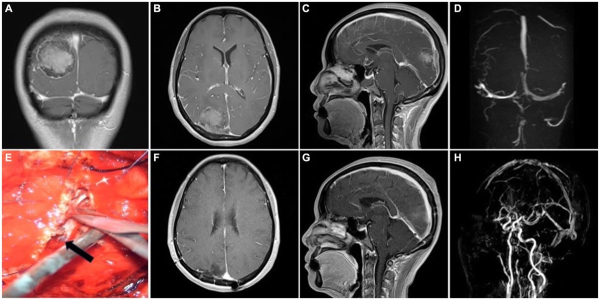 Type II parasagittal meningioma — preoperative enhanced MRI + MRV, intraoperative sinus-wall suture repair, postoperative MRI + MRV