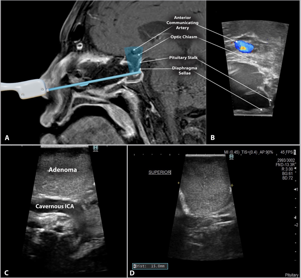 Endoscopic endonasal side-firing intraoperative ultrasound — parasellar anatomy with adenoma and the cavernous segment of the internal carotid artery