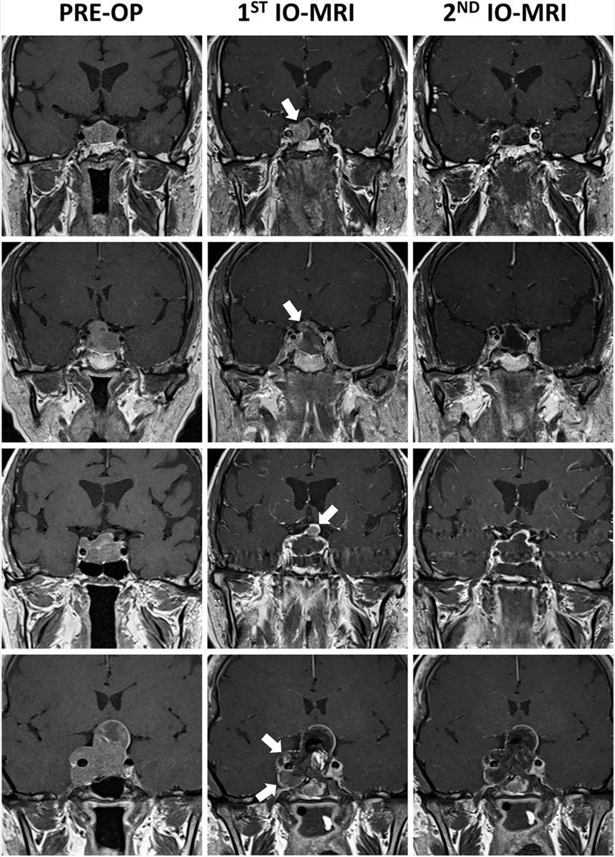 Pituitary macroadenoma — preoperative and intraoperative contrast coronal T1 MRI showing residual tumor at the sellar diaphragm and cavernous sinus