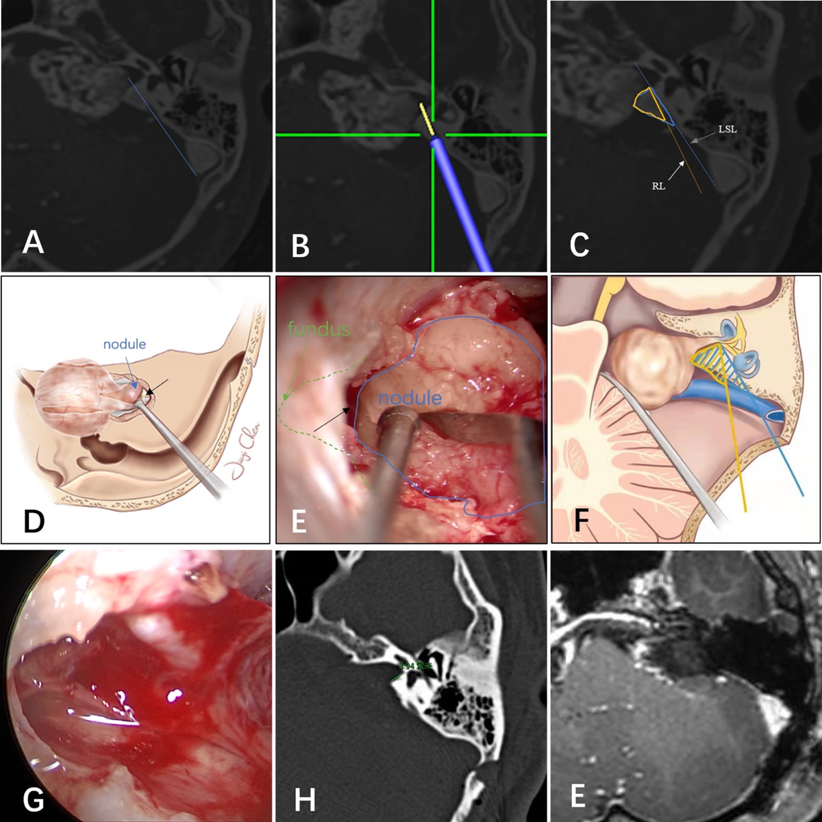 Intraoperative retrosigmoid microscopic view — intrameatal tumor at the IAC fundus with the tumor–nerve interface preserved