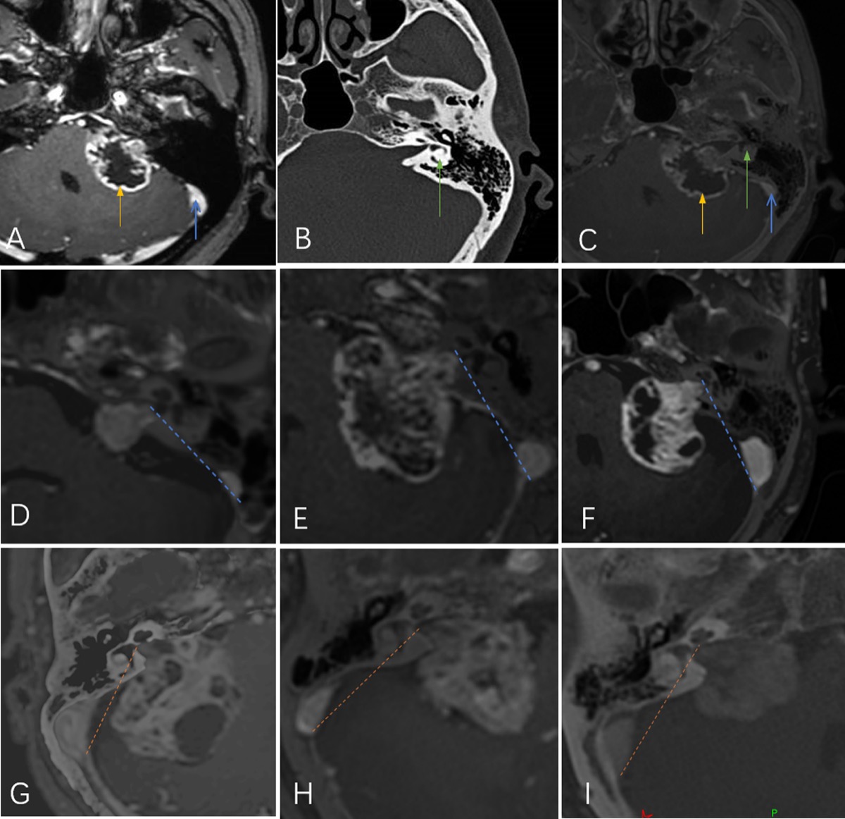 Vestibular schwannoma — MRI/CT fusion showing tumor, sigmoid sinus and labyrinth with lateral-safe-line classification