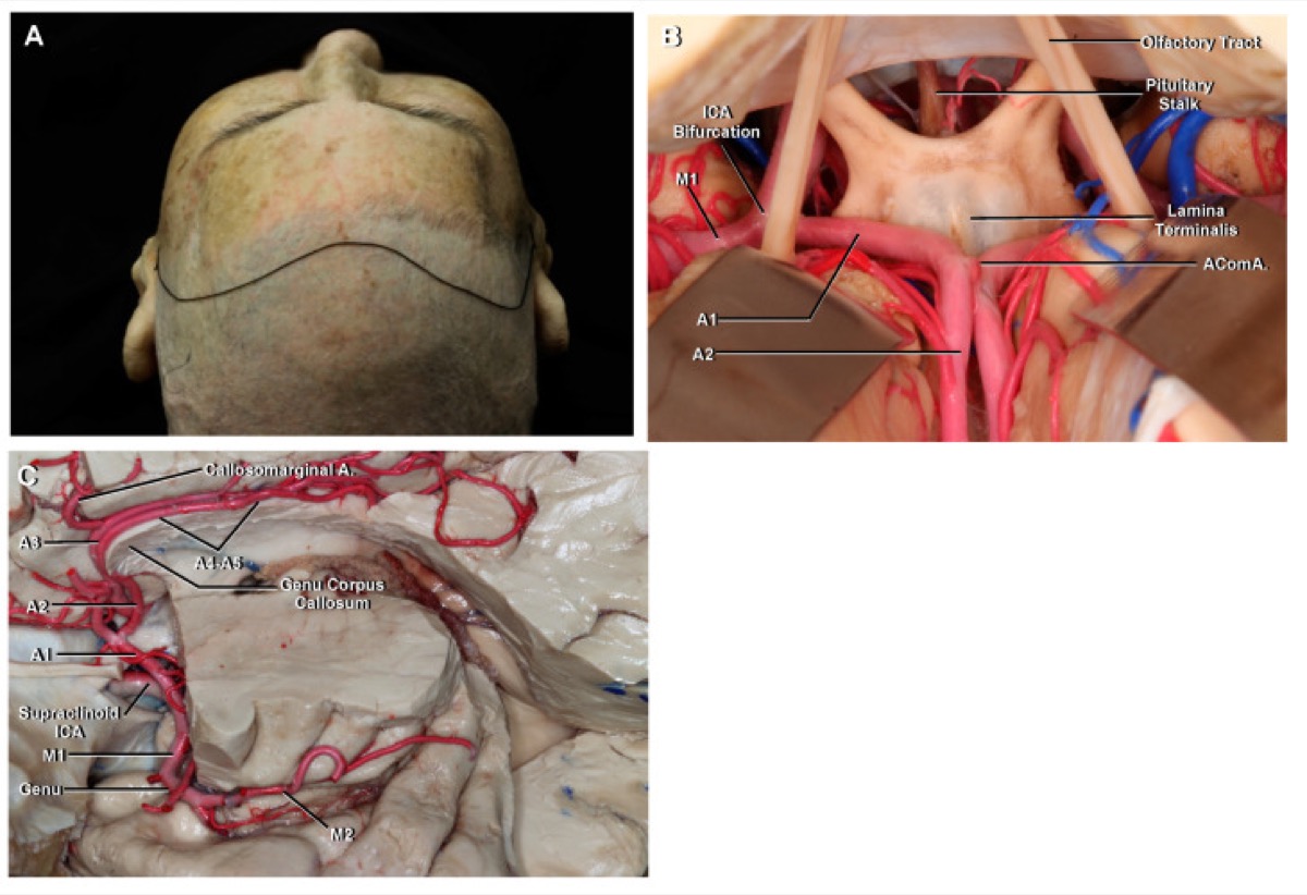 ACA / anterior communicating complex (A1–A2, perforators)