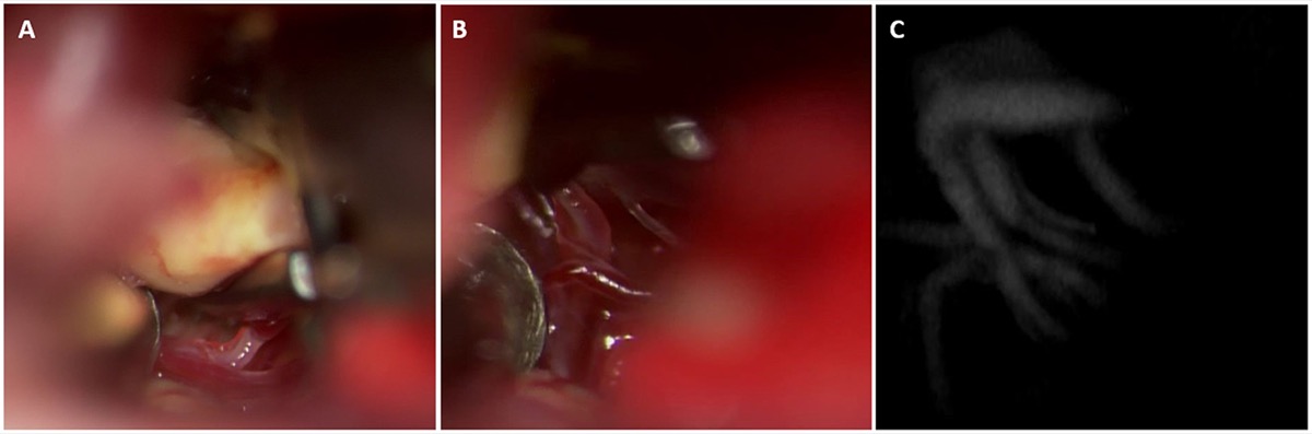 Basilar-apex aneurysm via orbitozygomatic approach — posterior perforators visualized (A), dissected off the dome and excluded from the clip construct (B), with post-clip ICG confirming perforator preservation (C)