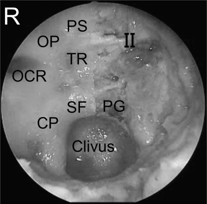 Approach Endoscopic Endonasal Approach — Fig. 1.