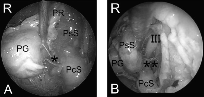 Approach Endoscopic Endonasal Approach — Fig. 2.