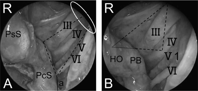 Approach Endoscopic Endonasal Approach — Fig. 3.