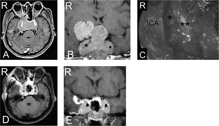 Approach Endoscopic Endonasal Approach — Fig. 4.