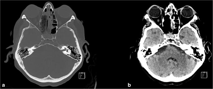 Approach Endoscopic Endonasal Approach — Fig. 3