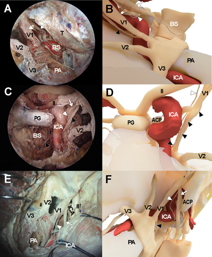 Approach Endoscopic Endonasal Approach — Figure 3