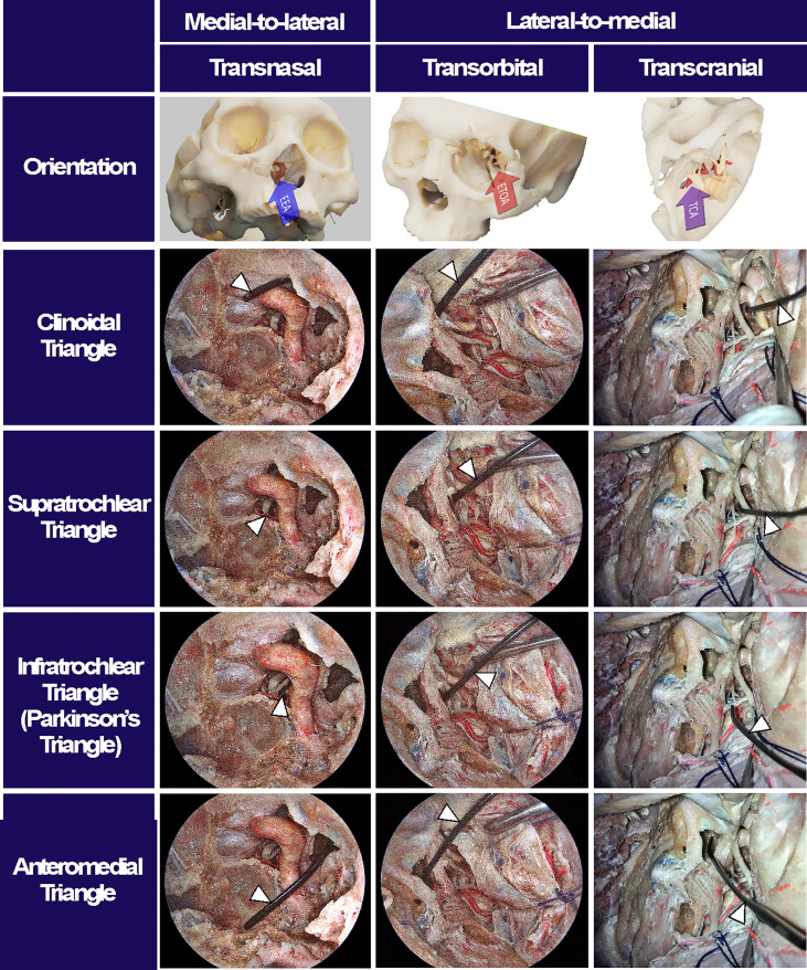 Approach Endoscopic Endonasal Approach — Figure 4