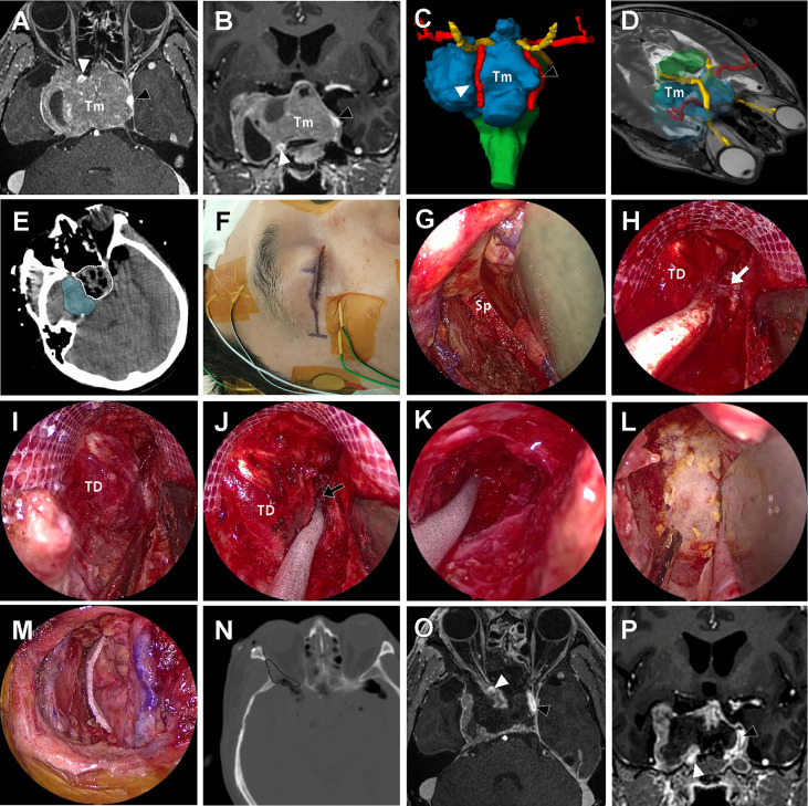 Approach Endoscopic Endonasal Approach — Figure 6