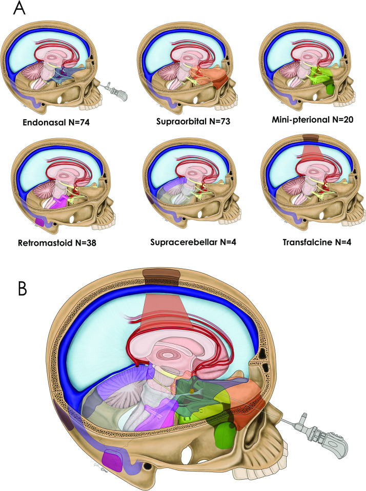 Approach Endoscopic Endonasal Approach — Fig 1