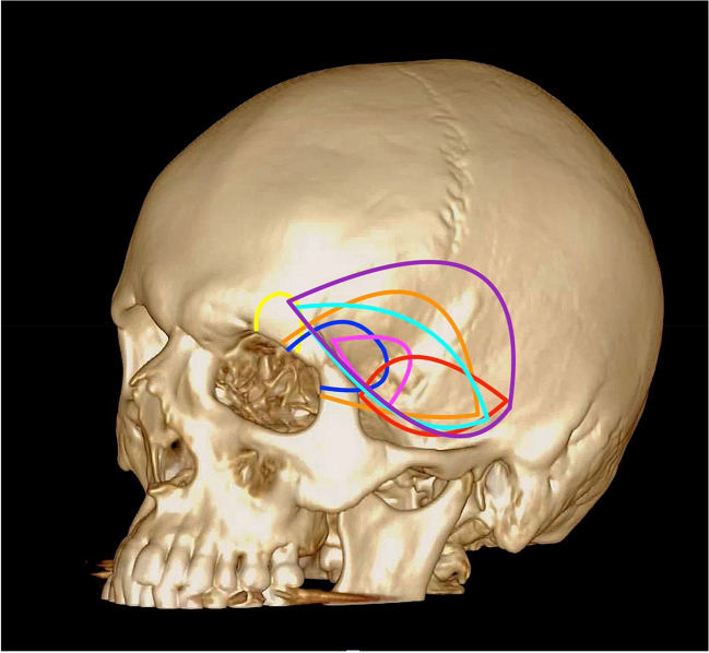 Approach Pterional Craniotomy — Fig. 2