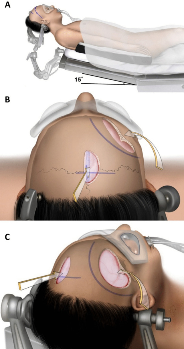 Approach Pterional Craniotomy — Fig. 3