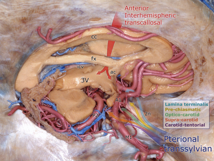 Approach Pterional Craniotomy — Fig. 4