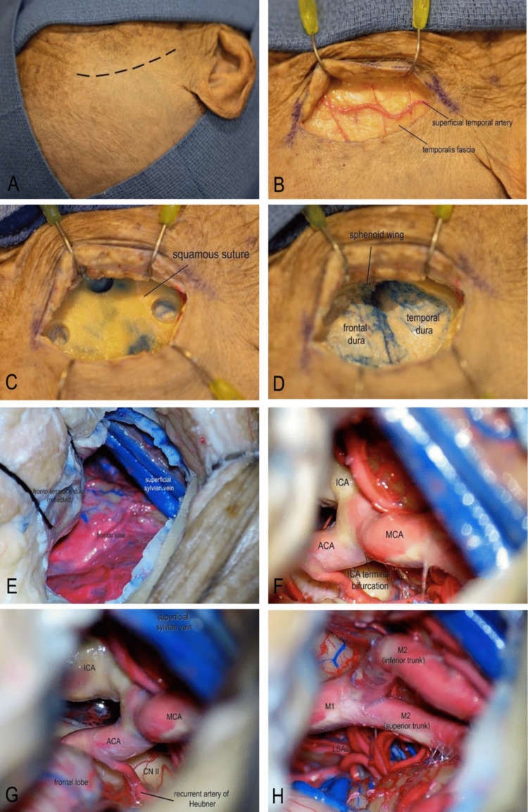 Approach Pterional Craniotomy — Fig. 1