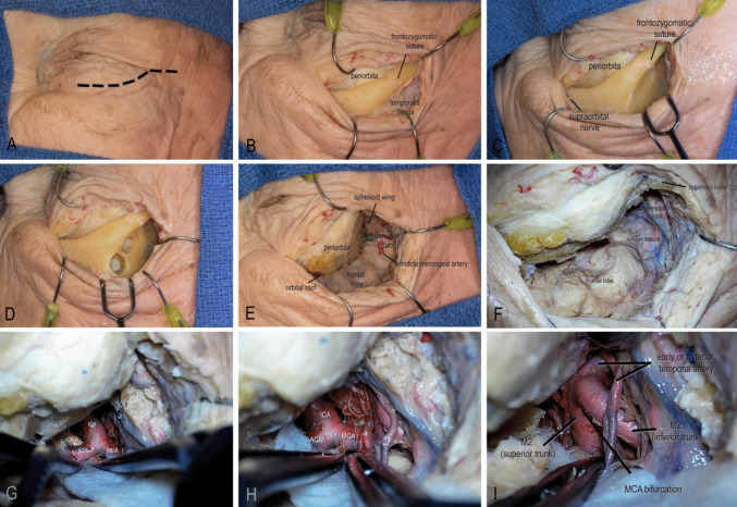 Approach Pterional Craniotomy — Fig. 2