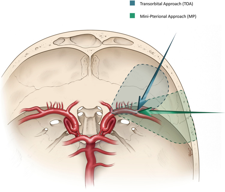 Approach Pterional Craniotomy — Fig. 3