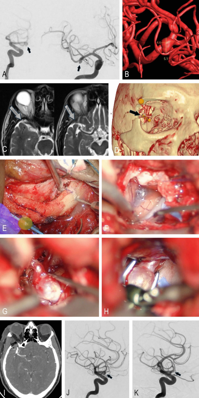 Approach Pterional Craniotomy — Fig. 5