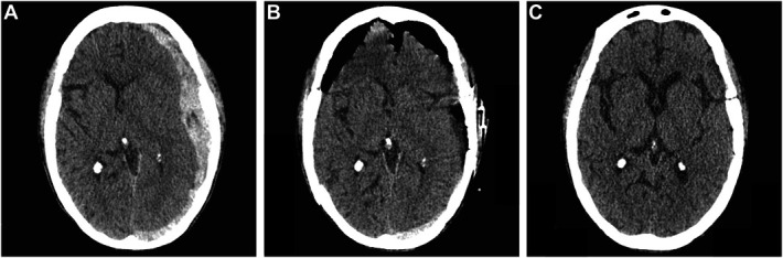 Acute Subdural Hematoma Craniotomy Craniectomy Evacuation — FIGURE 1.
