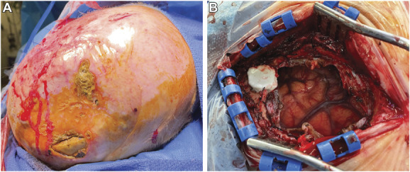 Acute Subdural Hematoma Craniotomy Craniectomy Evacuation — FIGURE 2.