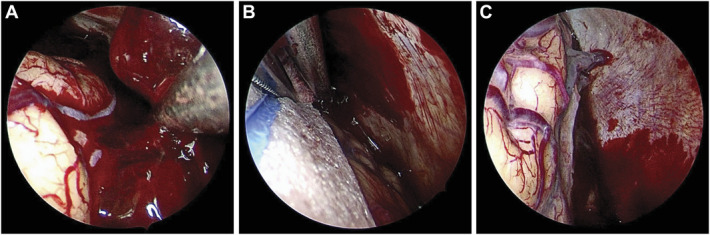 Acute Subdural Hematoma Craniotomy Craniectomy Evacuation — FIGURE 3.