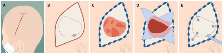 Acute Subdural Hematoma Craniotomy Craniectomy Evacuation — Figure 1
