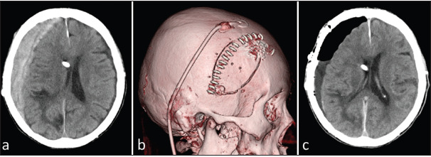 Acute Subdural Hematoma Craniotomy Craniectomy Evacuation — Figure 1: