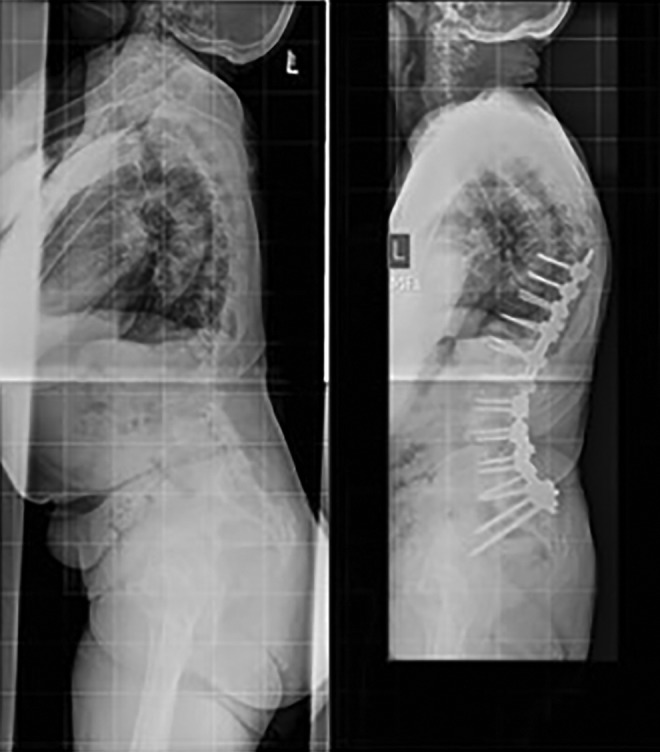 Adult Spinal Deformity Correction — Figure 1.