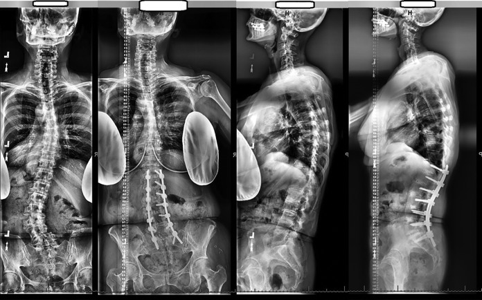 Adult Spinal Deformity Correction — Figure 2.