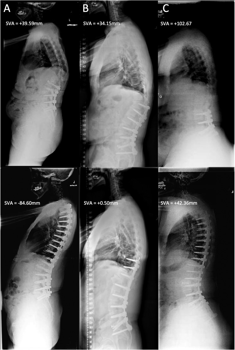Adult Spinal Deformity Correction — Figure 1.
