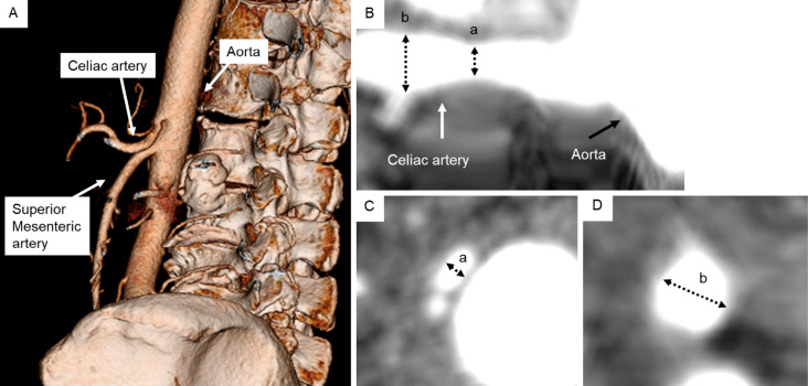 Adult Spinal Deformity Correction — Figure 1.