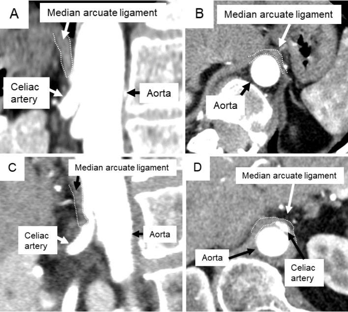 Adult Spinal Deformity Correction — Figure 2.
