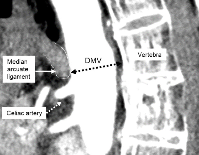 Adult Spinal Deformity Correction — Figure 4.
