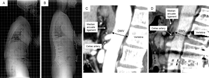 Adult Spinal Deformity Correction — Figure 5.