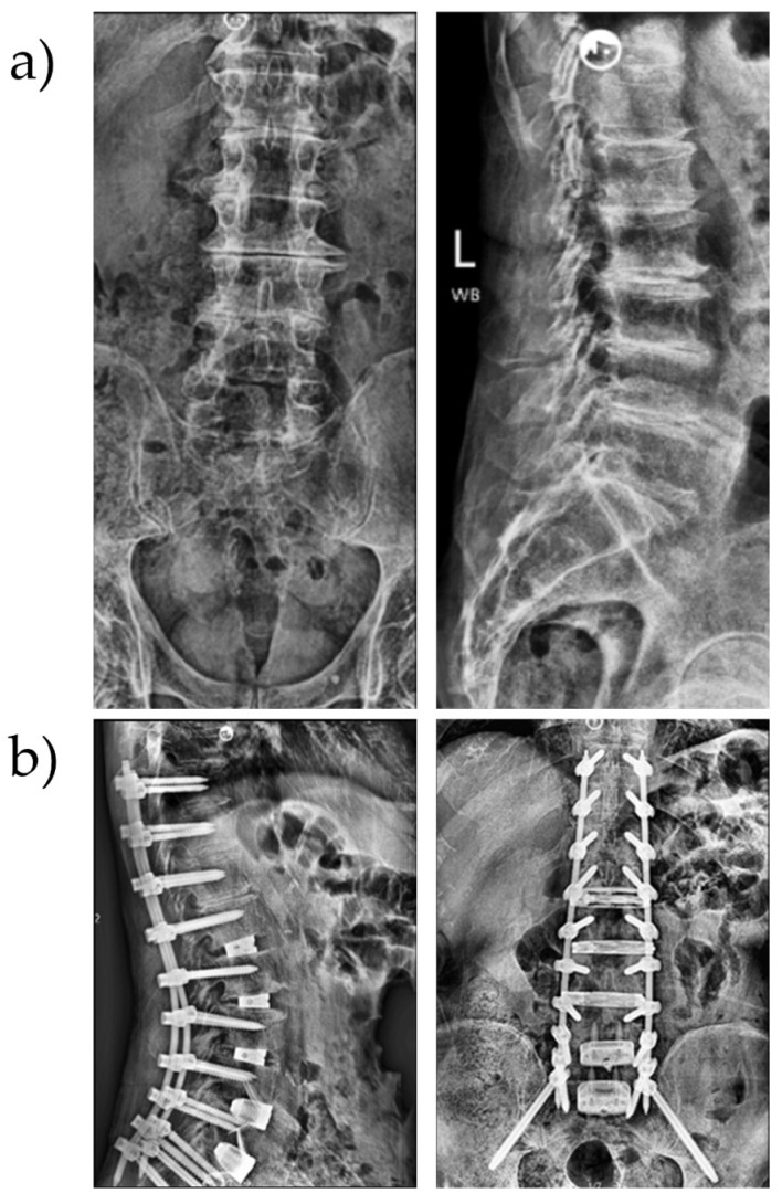 Adult Spinal Deformity Correction — Figure 1