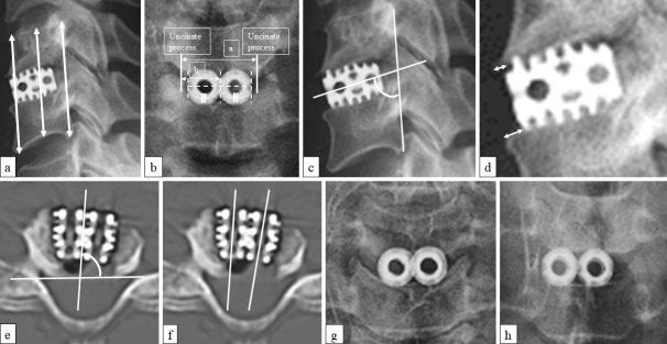 Anterior Cervical Discectomy Fusion — Fig. 1