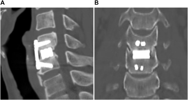 Anterior Cervical Discectomy Fusion — FIGURE 2